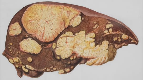 Kidney Stones in Women: Symptoms, Risks, Prevention, and When to Seek Help